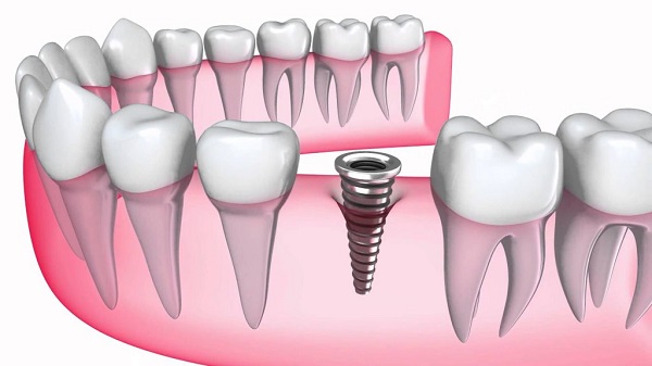 Vừa nhổ răng xong có được trồng răng Implant không | Nha khoa Việt Anh